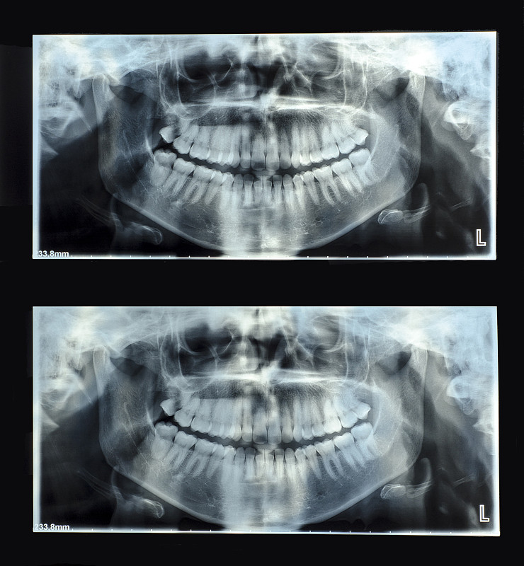全景牙科x光