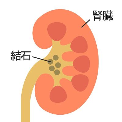 肾结石