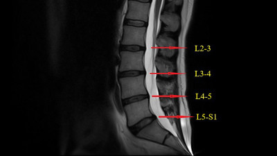 腰椎MRI(磁共振)下背部疼痛成像