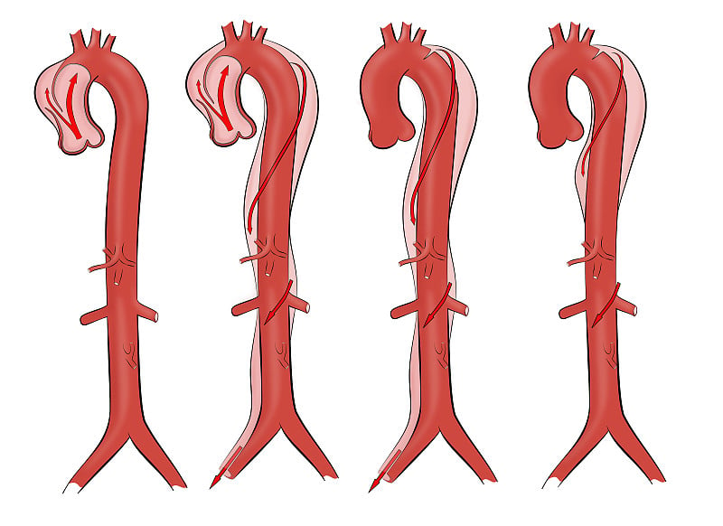 胸主动脉夹层。人体解剖学。