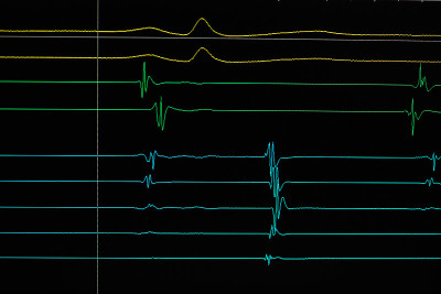 心cardiodiagram跟踪