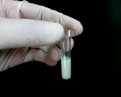 科学家手持黑色背景的血脂样本，血清样本中含有高甘油三酯