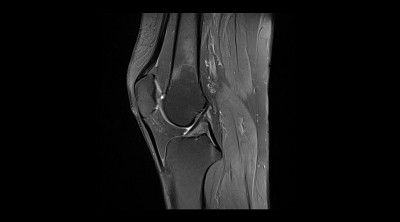 膝关节MRI(磁共振成像)