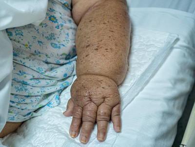 老年女性乳腺癌腋窝排空所致淋巴水肿