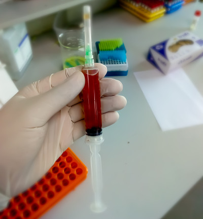 生化学师手持胸膜液样本注射器，准备进行生化测试(葡萄糖，蛋白质，ADA)。特写镜头