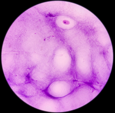 腕关节(FNA):神经节细胞，镜下可见泡沫组织细胞、淋巴细胞及背景蛋白