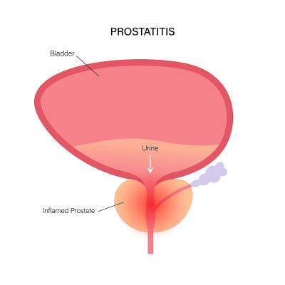 Prostatitis inflammation problem