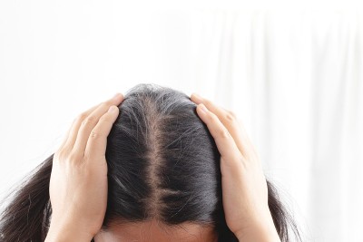 女性对洗发水过敏会导致脱发和头皮屑。