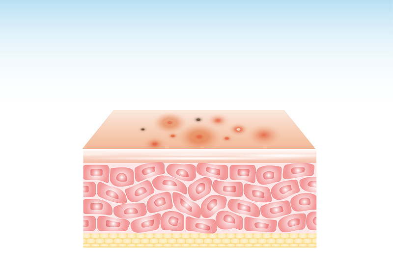 acne skin spot pimple problem vector design.