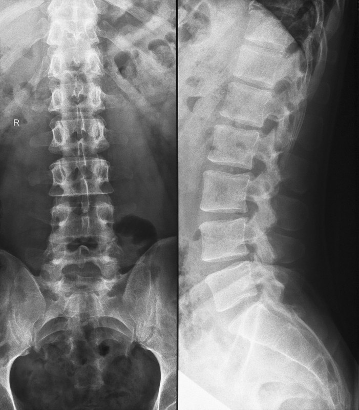 腰椎有轻微的s型脊柱侧凸