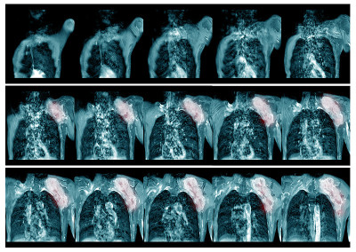 MRI Lt.shoulder病史:病例Lt.shoulder mass PE mass 20x20