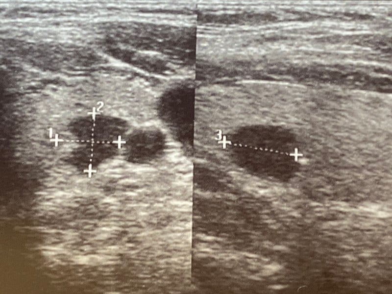 甲状腺囊性病变之超声检查