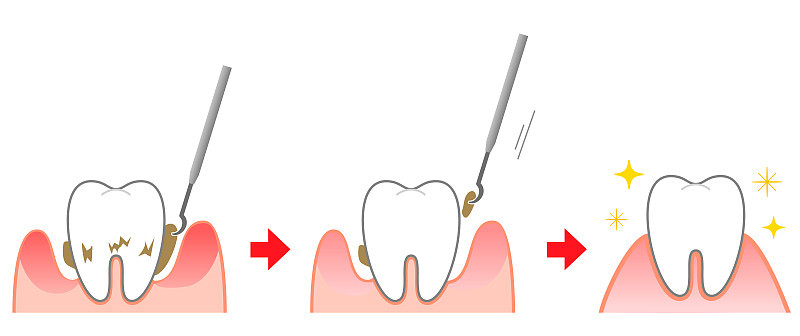 Periodontal disease bleeding toothpaste