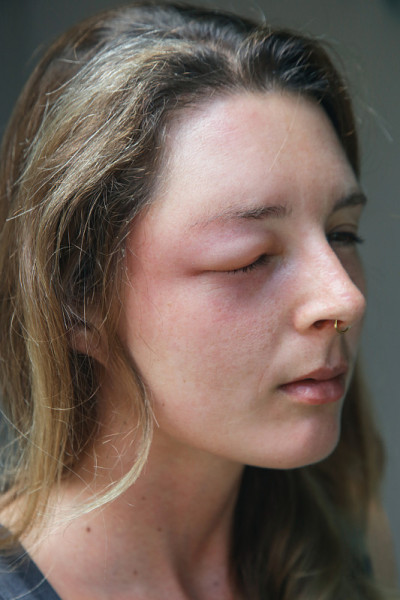 年轻的白种女人眼睛被黄蜂刺肿了。黄蜂叮咬后的过敏反应。