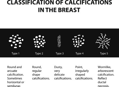 乳腺钙化的分类。乳房x光检查。乳腺。信息图。矢量插图在孤立的背景