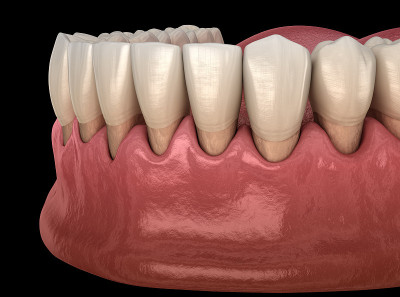 口香糖衰退过程。医用精准3D插图