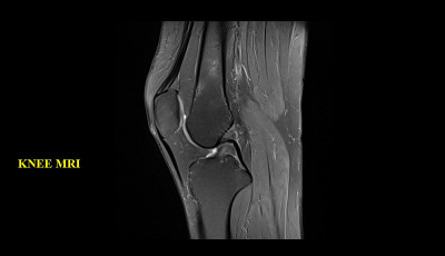 膝关节MRI(磁共振成像)