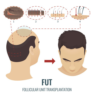 FUT脱发治疗