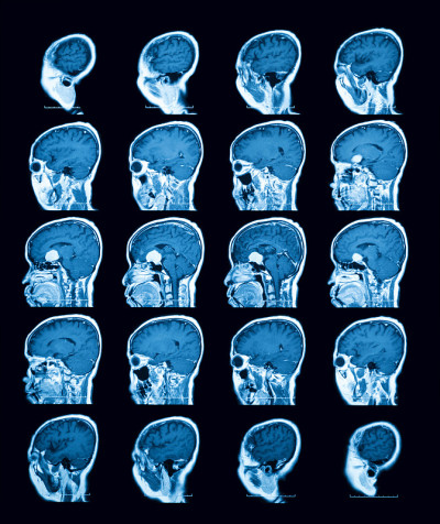 磁共振成像(MRI)扫描大脑，矢状面。