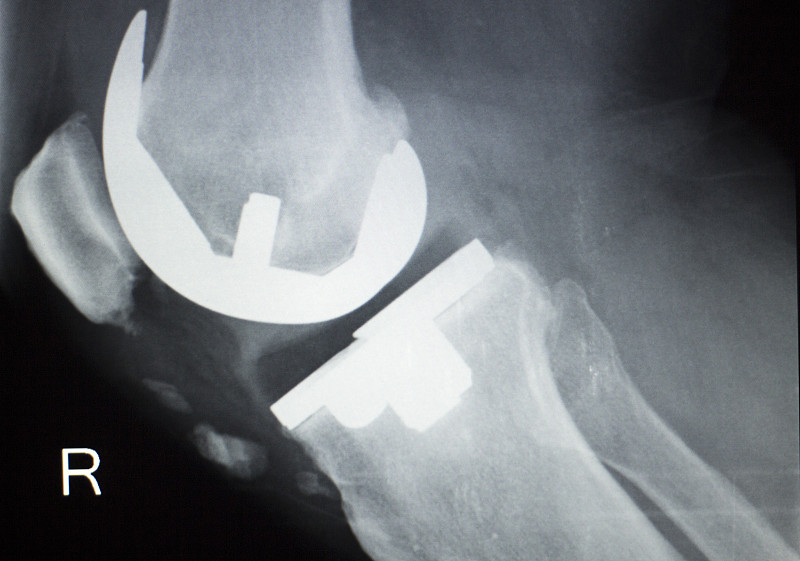 老年患者膝关节置换术骨科钛金属球窝植入物x线影像。