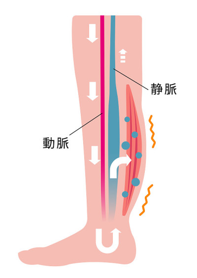 腿部肿胀(水肿)的原因。静脉漏水，出现肿胀。平面插图(日本)