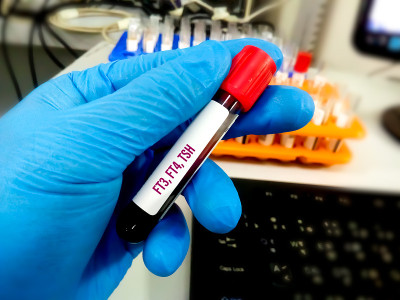 实验室甲状腺激素检查用试管血样。发生、FT4、TSH。甲状腺机能亢进或减退的诊断。实验室的背景。