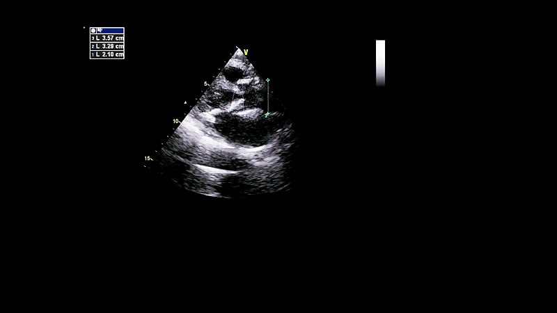 经食管超声检查心脏图像。
