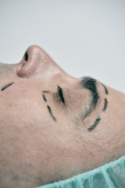 一个要做整形手术的男人