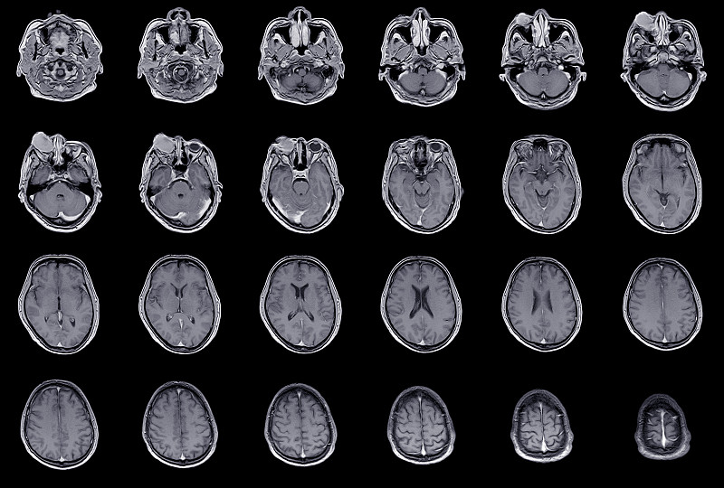 脑MRI及眼眶病史:右眼眶肿物生长1年，眼眶炎性病变(眼眶假瘤)。