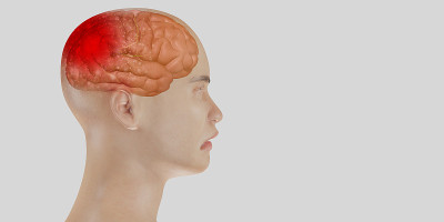 头痛的大脑系统问题头盖骨疼痛脸人显示头痛的3d插图