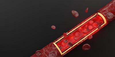 红血球皮肤层静脉三维插图血管内手术