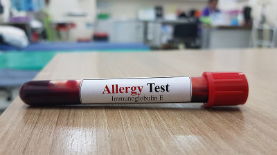 血液化验及过敏试验。过敏试验是通过测量IgE抗体来检测过敏原物质引起的过敏反应。医学调查和诊断技术概