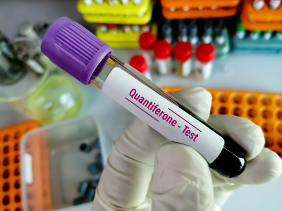 试管用血液样本进行Quantiferon试验，诊断结核分枝杆菌感染