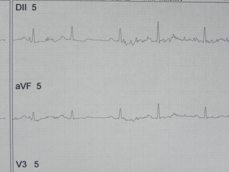 特写心电图(eletrocardiogram)