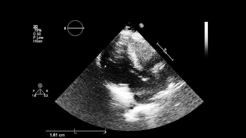 经食管超声检查心脏图像。