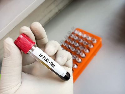 持有血液样本进行Lp-PLA2(脂蛋白相关磷脂酶A2)测试的科学家，心血管疾病