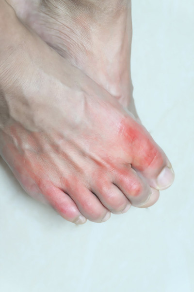 痛风病人脚。疼痛和发炎痛风。