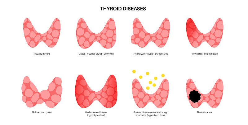 甲状腺疾病