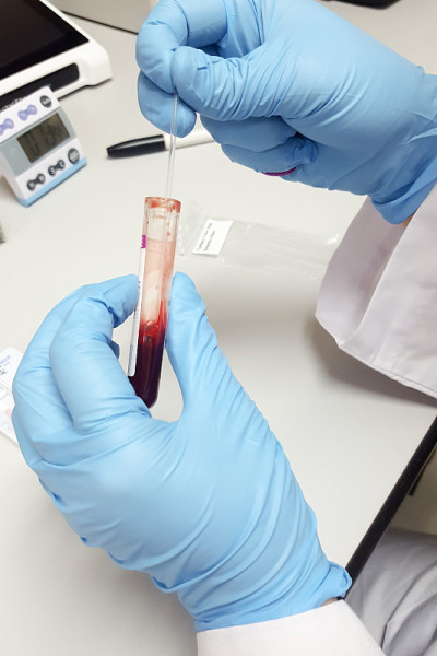 在大学研究实验室工作的手戴蓝手套的科学家或实验室技术人员，在科学室医院进行血液快速检测，将血样滴在平