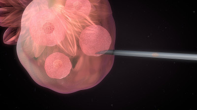体外受精(IVF)