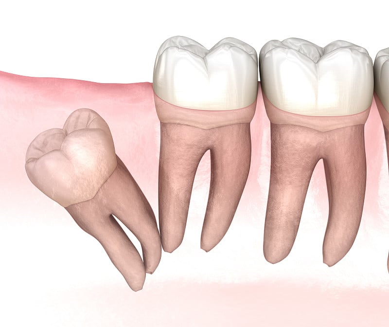 智齿远端嵌顿。医学上准确的牙齿3D插图