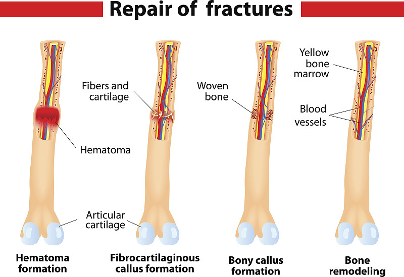 骨折愈合过程