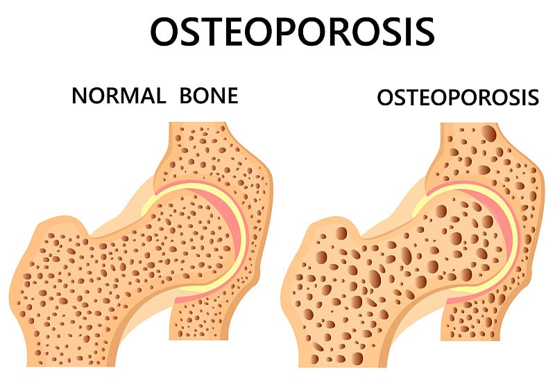 髋骨。健康，患有骨质疏松症