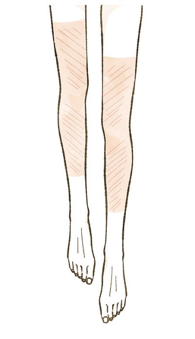 女性腿部有晒伤痕迹