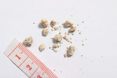 平躺或俯视图非常小的肾结石，尺在白色背景