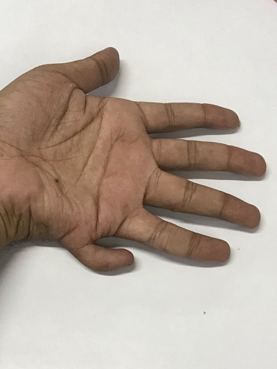 多指或多指畸形是指不正常的人手