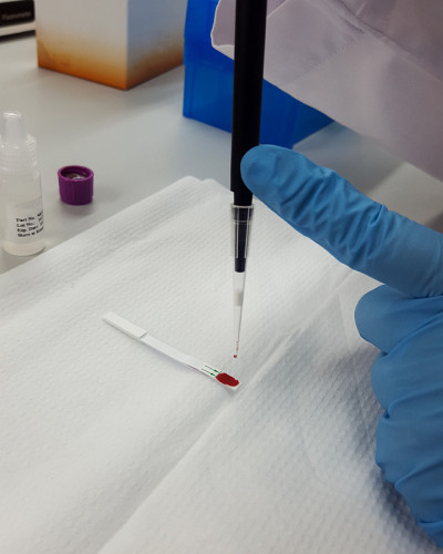 在大学研究实验室工作的手戴蓝手套的科学家或实验室技术人员，在科学室医院进行血液快速检测，将血样滴在平