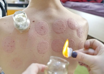 传统的Hijama治疗和健康疗法
