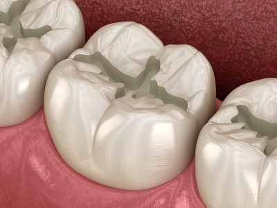 准备的磨牙裂填补安置，医学上精确的3D插图牙科概念