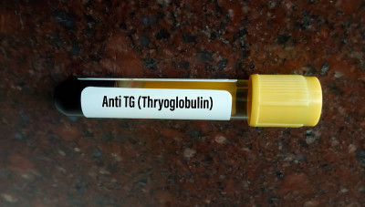 血液样本作抗甲状腺抗体测试。系统性红斑狼疮疾病诊断。抗TG(抗甲状腺球蛋白)。